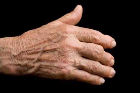 evidence of arthritis in old age