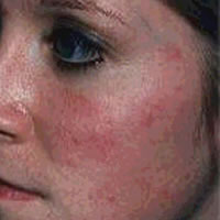 signs of Rosacea